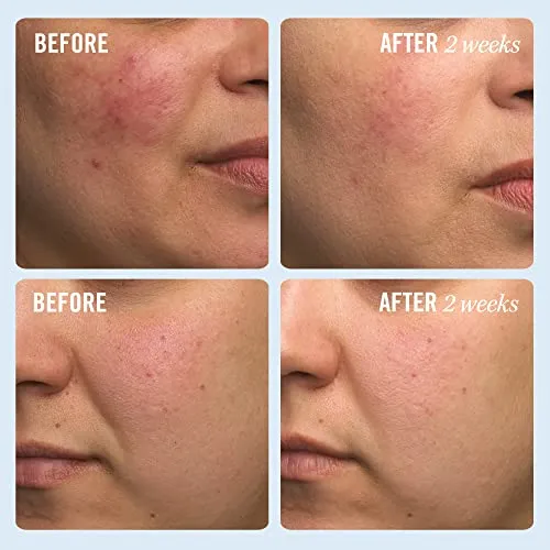 First Aid Beauty Ultra Repair Cream Intense Hydration Moisturizer for Face and Body – 6 oz.