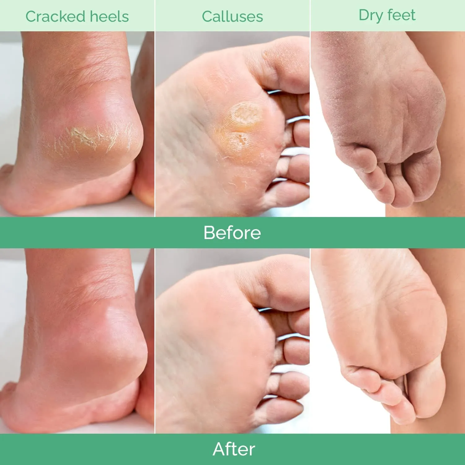 Foot Peeling Mask 2 Pack | Dermatologically Tested Repairs Heels & Removes Dry Dead Skin for Baby Soft Feet | Exfoliating Foot Peel Mask for Dry Cracked Feet | Strawberry